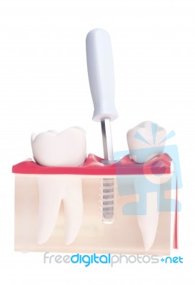 Implant Dental Model Stock Photo