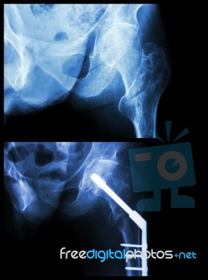 Intertrochanteric Fracture Left Femur (fracture Thigh's Bone). It Was Operated And Insert Intramedullary Nail Stock Photo