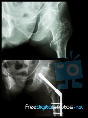 Intertrochanteric Fracture Left Femur (fracture Thigh's Bone). It Was Operated And Insert Intramedullary Nail Stock Photo