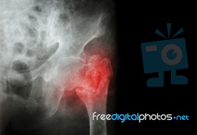 Intertrochanteric ( Neck Of Femur ) Fracture Left Femur ( Thigh Bone ) And Blank Area At Right Side Stock Photo