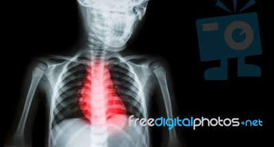 Ischemic Heart Disease , Myocardial Infarction ( Mi ) ( Film X-ray Body Of Human With Heart Disease And Blank Area At Right Side ) ( Cardiopulmonary Resuscitate And Cardiovascular Concept ) Stock Photo