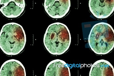 Ischemic Stroke : ( Ct Of Brain Show Cerebral Infarction At Left Frontal - Temporal - Parietal Lobe ) ( Nervous System Background ) Stock Photo