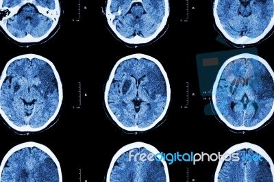Ischemic Stroke : ( Ct Of Brain Show Cerebral Infarction At Left Frontal - Temporal - Parietal Lobe ) ( Nervous System Background ) Stock Photo
