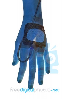 Iv Solution In Patients Hand Stock Image