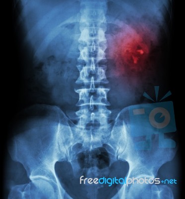 Kidney Stone ( Renal Stone , Renal Calculi ) ( Film X-ray Kub ( Kidney - Ureter - Bladder ) Show Left Renal Stone ) Stock Photo