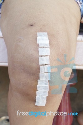 Knee Replacement Incision Stock Photo