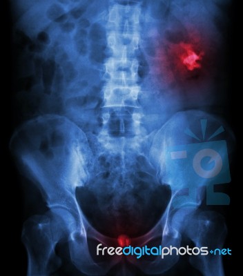 Left Kidney Stone(opaque Area At Right Upper Of Image) And Bladd… Stock Photo