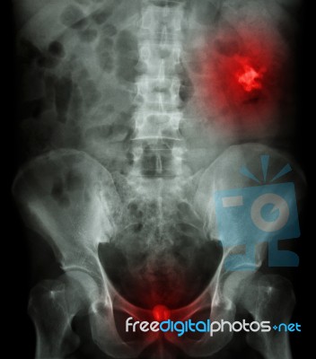 Left Kidney Stone(opaque Area At Right Upper Of Image) And Bladd… Stock Photo