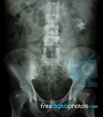 Left Kidney Stone(opaque Area At Right Upper Of Image) And Bladd… Stock Photo