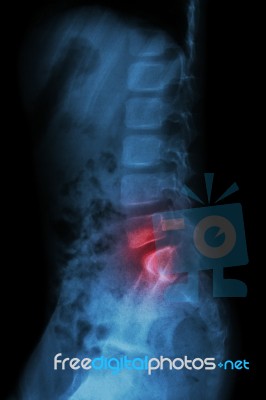 Lumbar Spine Of Child And Inflammation At Lumbar Spine ( Low Back Pain ) ( X-ray Thoracic - Lumbar Spine ) ( Lateral View ) Stock Photo