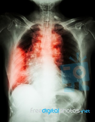 Lung Cancer .  Film Chest X-ray Show Right Lung Mass , Wide Mediastinum , Pneumonia And Right Pleural Effusion Stock Photo