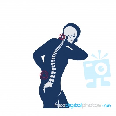 Medical Concept Illustration Of Musculotendinous Strain Back Ache Or Lumbar Pain Stock Image