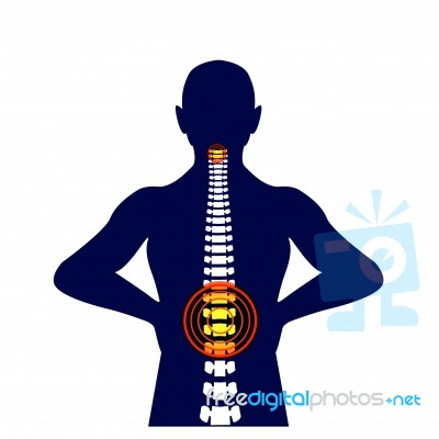 Medical Concept Illustration Of Musculotendinous Strain Back Ache Or Lumbar Pain Stock Image