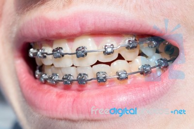 Mouth With Bracket Stock Photo