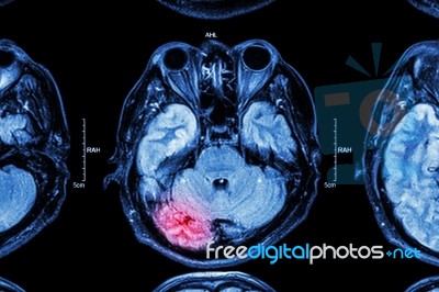 Mri Of Brain : Brain Injury Stock Photo