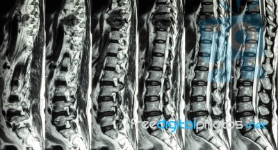 Mri Of Lumbar & Thoracic Spine : Show Fracture Of Thoracic Spine And Compress Spinal Cord ( Myelopathy ) Stock Photo