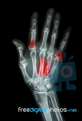 Multiple Fracture At Index,little Finger,metacarpal Bone Stock Photo