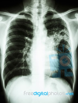 Mycobacterium Tuberculosis Infection (pulmonary Tuberculosis) Stock Photo