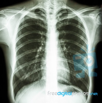 Normal Human's Chest Stock Photo