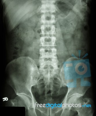 Normal Human's Lumbosacral Spine Stock Photo Normal Human's Lumbosacral Spine Stock Photo