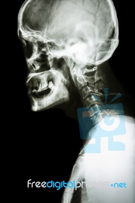 Normal Human's Skull And Cervical Spine Stock Photo