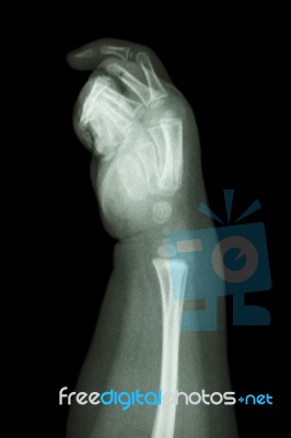 Normal Infant's Hand Bone Stock Photo