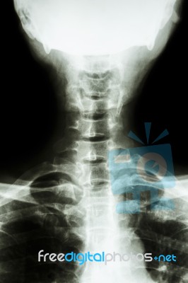 Normal Thai Man's Cervical Spine Stock Photo