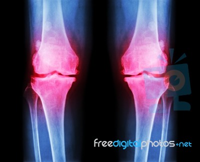 Osteoarthritis Both Knee .  Film X-ray Ap ( Anterior - Posterior ) Of Knee Show Narrow Joint Space , Osteophyte ( Spur ) , Subcondral Sclerosis Stock Photo