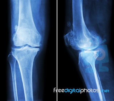 Osteoarthritis Knee . Film X-ray Knee ( Anterior - Posterior And Lateral View ) Show Narrow Joint Space , Osteophyte ( Spur ) , Subcondral Sclerosis Due To Degenerative Change Stock Photo Osteoarthritis Knee . Film X-ray Knee ( Anterior - Posterior And Lateral View ) Show Narrow Joint Space , Osteophyte ( Spur ) , Subcondral Sclerosis Due To Degenerative Change Stock Photo