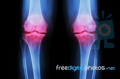 Osteoarthritis Knee ( Oa Knee ). Film X-ray Both Knee ( Front View ) Show Narrow Joint Space ( Joint Cartilage Loss ) , Osteophyte , Subchondral Sclerosis Stock Photo