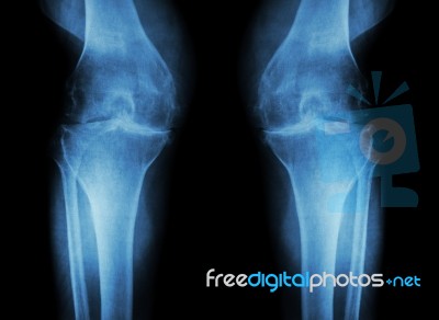 Osteoarthritis Knee ( Oa Knee ) ( Film X-ray Both Knee With Arthritis Of Knee Joint : Narrow Knee Joint Space ) ( Medical And Science Background ) Stock Photo