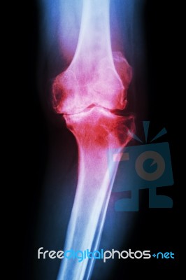 Osteoarthritis Knee Patient Stock Photo