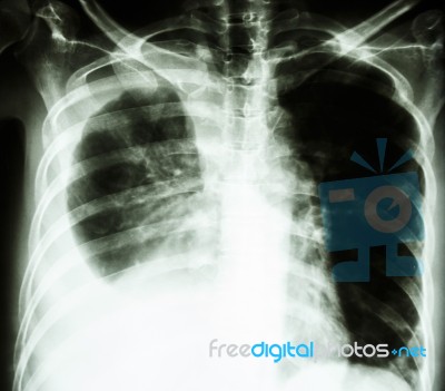 Pleural Effusion Due To Lung Cancer Stock Photo