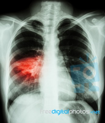 Pneumonia ( Film Chest X-ray Show Alveolar Infiltrate At Right Middle Lung ) ( Image For Pulmonary Tuberculosis , Mers-cov , Sars ) Stock Photo