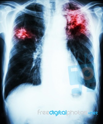 Pulmonary Tuberculosis Stock Photo