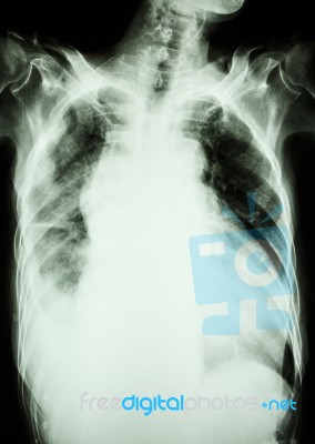Pulmonary Tuberculosis And Right Lung Effusion Stock Photo Pulmonary Tuberculosis And Right Lung Effusion Stock Photo
