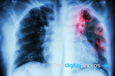 Pulmonary Tuberculosis .  Chest X-ray : Interstitial Infiltratio… Stock Photo