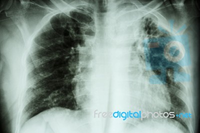 Pulmonary Tuberculosis .  Chest X-ray : Interstitial Infiltratio… Stock Photo