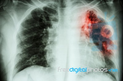 Pulmonary Tuberculosis . Chest X-ray : Interstitial Infiltratio… Stock Photo Pulmonary Tuberculosis . Chest X-ray : Interstitial Infiltratio… Stock Photo