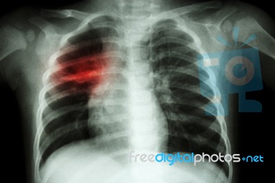 Pulmonary Tuberculosis ( Chest X-ray Of Child : Show Patchy Infiltration At Right Middle Lung ) Stock Photo