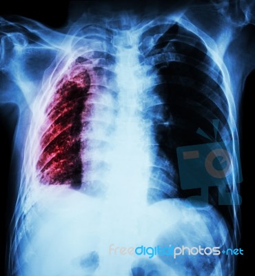 Pulmonary Tuberculosis .   Chest X-ray : Right Lung Atelectasis Stock Photo