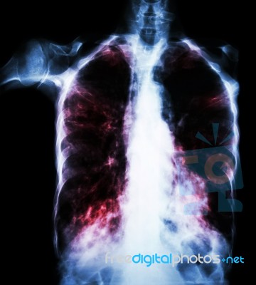 Pulmonary Tuberculosis  ( Film Chest X-ray :  Interstitial Infiltrate Both Lung Due To Mycobacterium Tuberculosis Infection ) Stock Photo