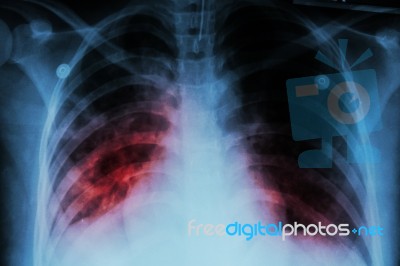 Pulmonary Tuberculosis ( Tb )  :  Chest X-ray Show Alveolar Infiltration At Both Lung Due To Mycobacterium Tuberculosis Infection Stock Photo