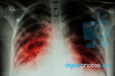 Pulmonary Tuberculosis ( Tb )  :  Chest X-ray Show Alveolar Infiltration At Both Lung Due To Mycobacterium Tuberculosis Infectionpulmonary Tuberculosis ( Tb )  :  Chest X-ray Show Alveolar Infiltration At Both Lung Due To Mycobacterium Tuberculosis Infecti Stock Photo