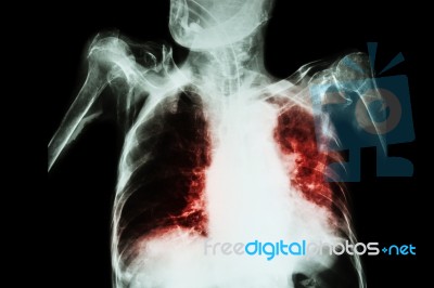 Pulmonary Tuberculosis With Acute Respiratory Failure ( Film Chest X-ray Of Old Patient Show Alveolar And Interstitial Infiltration Both Lung With Endotracheal Tube ) Due To Mycobacterium Tuberculosis Stock Photo