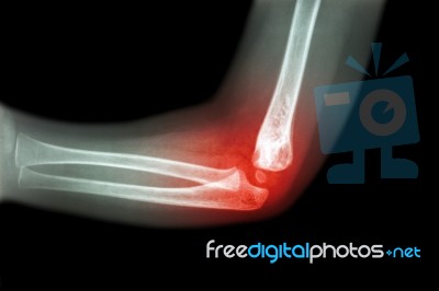 Rheumatoid Arthritis , Gouty Arthritis ( Film X-ray Child 's Elbow With Arthritis At Elbow ) ( Side View , Lateral ) Stock Photo