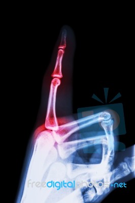 Rheumatoid Arthritis , Gouty Arthritis ( Film X-ray Index Finger And Hand ( Point A Finger ) And Inflame At Finger ) Stock Photo