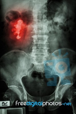 Right Renal Calculi (staghorn) Stock Photo