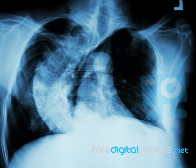 Scoliosis ( Crooked Spine ) X-ray Chest Of Old People With Croo… Stock Photo Scoliosis ( Crooked Spine ) X-ray Chest Of Old People With Croo… Stock Photo