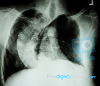 Scoliosis ( Crooked Spine ) X-ray Chest Of Old People With  Croo… Stock Photo